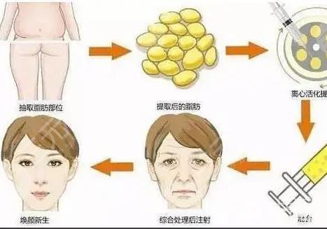 自體脂肪填充下眼瞼凹陷有哪些優(yōu)勢(shì)和弊端?