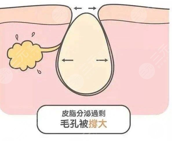 什么醫(yī)美項目收縮毛孔果好？近幾年爆款醫(yī)美項目云集，總有一款適合你~
