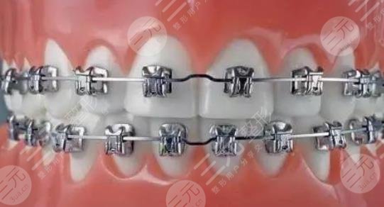 牙齒矯正