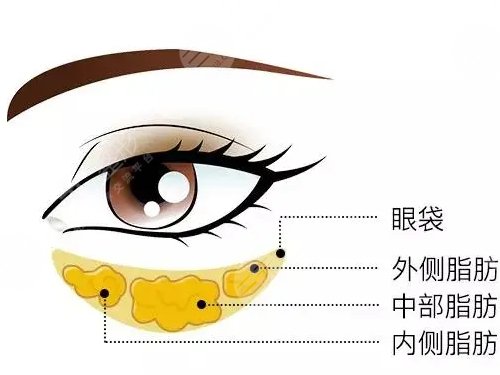 怎么去眼袋快有？