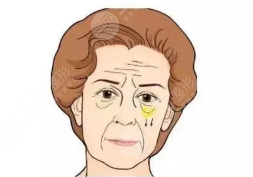 怎么去眼袋快有？