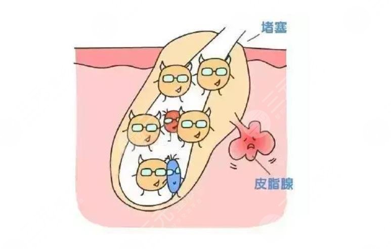 如何消除青春痘疤痕?痘印?