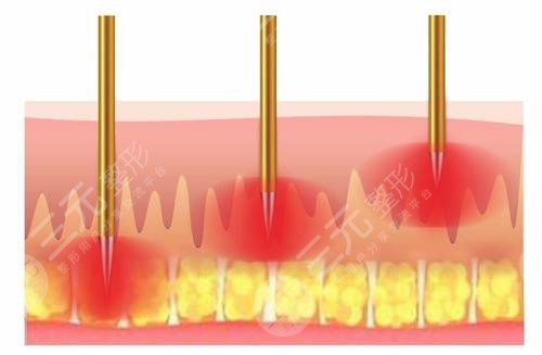去紅痘印術前要準備什么工作?