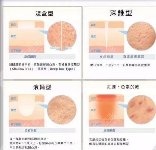 點陣祛痘坑手術要多久才能恢復?