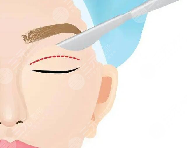 全切雙眼皮手術(shù)