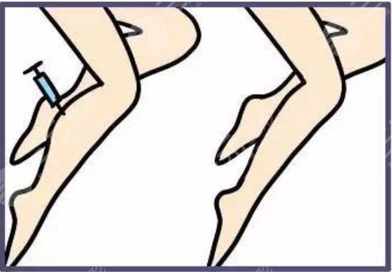 瘦小腿有的方法有哪些？見快且操作簡(jiǎn)單的方案，長(zhǎng)期堅(jiān)持果驚艷~