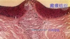 如何防止傷口留下疤痕？快速祛疤方式有哪些？