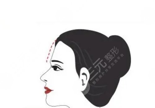 額頭窄豐額頭要多少錢?