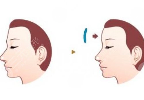 額頭窄豐額頭要多少錢?