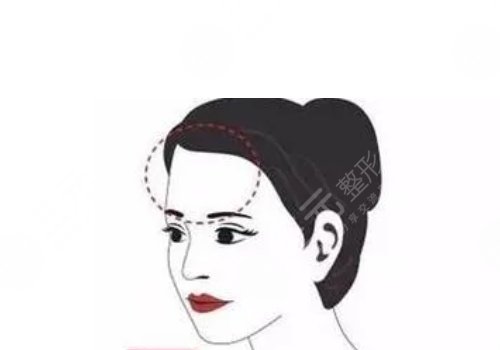 額頭窄豐額頭要多少錢?