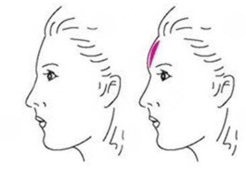 額頭窄豐額頭要多少錢?