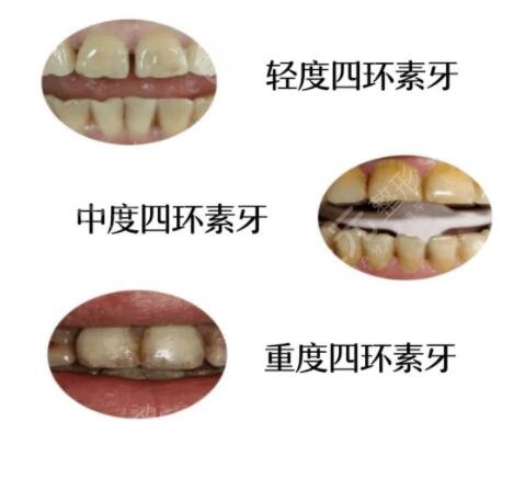 四環(huán)素牙如何改良?
