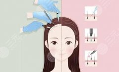 【植發(fā)】發(fā)際線高怎么治？發(fā)際線過高植發(fā)需要多少錢？