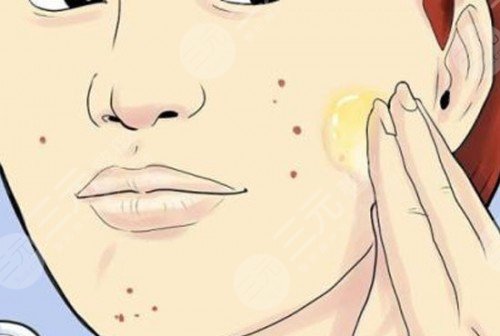 光子去痘手術(shù)注意事項(xiàng)