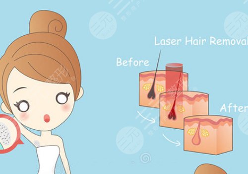 光子脫毛需要幾次能脫干凈?