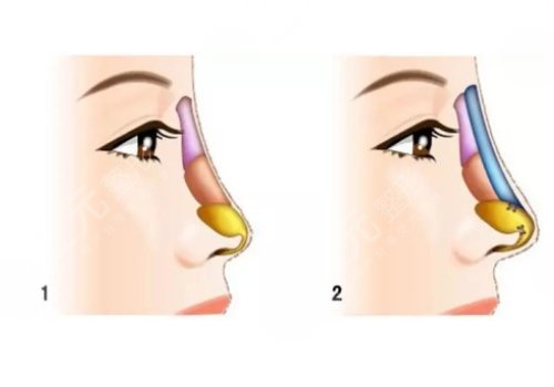 硅膠假體隆鼻一般維持多久?