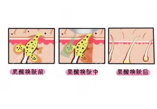 果酸換膚的功有什么?