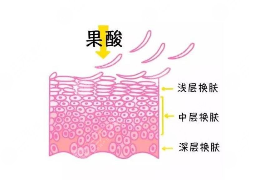 果酸換膚費(fèi)用大概?多少?