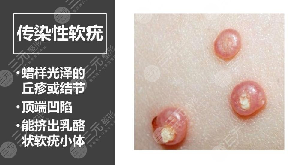 猴子是什么皮膚病?