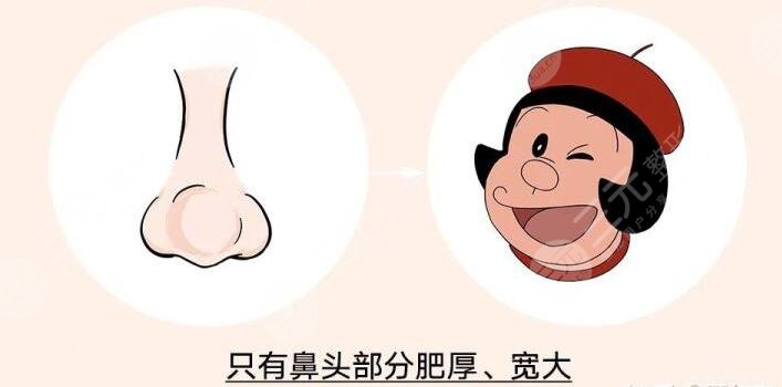 　　蒜頭鼻整形前后對(duì)比，小編通過調(diào)查了解到，有許多小伙伴正在飽受蒜頭鼻帶來的不好的影響，蒜頭鼻又被稱為大鼻頭，無論男生還是女生，一旦長(zhǎng)成蒜頭鼻，就會(huì)讓整個(gè)人看起來面部的不協(xié)調(diào)，影響美觀程度，而且如果鼻頭很大的話，咱們看這個(gè)人的大部分眼光就會(huì)集中在鼻頭，并且忽略面部其他地方。除此之外，蒜頭鼻的小伙伴們?cè)诨瘖y的時(shí)候也會(huì)感到特別煩惱。所以有一些小伙伴會(huì)去做蒜頭鼻整形手術(shù)，收獲一個(gè)小巧好看的鼻頭。  　　一、蒜頭鼻整形手術(shù)原理  　　蒜頭鼻的形成原因是因?yàn)楸穷^部分的脂肪組織比較厚，鼻翼的軟骨發(fā)育過度或者鼻翼軟骨發(fā)育過程中往后縮，從而造成了蒜頭鼻。在進(jìn)行蒜頭鼻矯正手術(shù)的過程當(dāng)中，醫(yī)生是通過切除鼻子部分多余的軟骨和脂肪組織，然后將鼻頭聚攏縫合，在傷口愈合過后，就可以收獲一個(gè)又細(xì)又直的小巧好看的鼻子。這類手術(shù)的切口微小，傷口不，愈合過后也不容易看出切口的痕跡，愛美的小伙伴可以詳細(xì)去了解蒜頭鼻整形手術(shù)，判斷自己的鼻頭形狀，再進(jìn)行手術(shù)改良。  　　二、蒜頭鼻的分類  　　首先咱們的鼻翼軟骨發(fā)育過度會(huì)導(dǎo)致蒜頭鼻，這樣的蒜頭鼻整個(gè)人的鼻頭看起來又大又大，的不好看，但是改良的方法是比較簡(jiǎn)單的，可以直接將發(fā)育過度的鼻翼軟骨切除掉，或者可以將鼻翼軟骨聚攏再縫合，也能達(dá)到收縮鼻翼的果。其次是鼻頭的軟組織肥厚，造成的蒜頭鼻，這種蒜頭鼻的特征是，起來肉乎乎的軟綿綿的。  　　要進(jìn)行手術(shù)調(diào)整的話，就需要切除鼻子的部分軟組織，這種改良手術(shù)考驗(yàn)醫(yī)生的手術(shù)技術(shù)，如果醫(yī)生在手術(shù)過程當(dāng)中操作不當(dāng)?shù)脑?，就很可能?huì)導(dǎo)致鼻頭的軟組織增生，會(huì)讓鼻頭越來越大，變成大蒜頭鼻。后就是鼻尖很矮，就會(huì)顯得鼻頭很塌，這類蒜頭鼻就不需要切除鼻部組織，可以通過抬高鼻尖來達(dá)到縮小鼻翼的果，這類改良方式是相對(duì)來說簡(jiǎn)單的。  　　三、蒜頭鼻整形前后對(duì)比  　　小編的大學(xué)室友就是一個(gè)典型的蒜頭鼻女孩，不看鼻頭的話，她皮膚白皙有光澤，眼睛大雙眼皮嘴巴小巧，臉型也是標(biāo)準(zhǔn)的鵝蛋臉，看起來的好看，但是美中不足的是，她的鼻頭看起來的大，肉嘟嘟的，也就顯得她的山根很低，這就使得她的顏值降低了百分之五十，特別是嘴巴小巧就更顯得鼻頭大，整個(gè)人看起來就不再精致，顯得比較憨厚老實(shí)。前段時(shí)間，她在朋友的推薦下，準(zhǔn)備通過整形手術(shù)來改良自己的蒜頭鼻。  　　她講述到，她去到了整形醫(yī)院，整形醫(yī)生根據(jù)她的鼻頭設(shè)計(jì)了切除鼻部多余軟組織的手術(shù)方案。醫(yī)院安排了一位臨床經(jīng)驗(yàn)豐富的整形醫(yī)生，為她進(jìn)行了切除鼻部軟組織的手術(shù)。術(shù)后一周左右，她發(fā)現(xiàn)自己的鼻頭沒有腫脹感了，整體的恢復(fù)也比較快，她自己也感覺到鼻頭的縮小了。  　　術(shù)后一個(gè)月左右，她的鼻子已經(jīng)變得的好看，因?yàn)槿馊獾谋穷^被切除縮小了，也就讓她的山根顯得高挺起來，鼻頭變得小巧精致，整個(gè)人的顏值大大的提升，從一個(gè)面相憨厚的女生變成了大美女。她本人也變得更加自信，以前拍照只敢露半張臉的她，現(xiàn)在拍照能夠大大方方露全臉，不用再因?yàn)樽约旱乃忸^鼻被家人朋友嘲笑了。  　　小編希望所有和我大學(xué)室友有相同困擾的小伙伴，可以勇敢的面對(duì)自己的蒜頭鼻，自信的走進(jìn)整形醫(yī)院，做一場(chǎng)適合自己的蒜頭鼻整形手術(shù)，從根本上改良自己的顏值，讓自己也能在自己的生活圈里面自信放光芒。