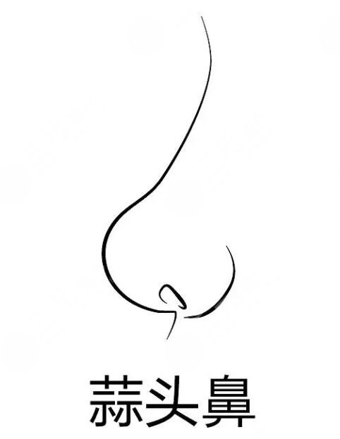 蒜頭鼻整形前后對(duì)比