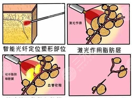 等離子激光溶脂果如何？