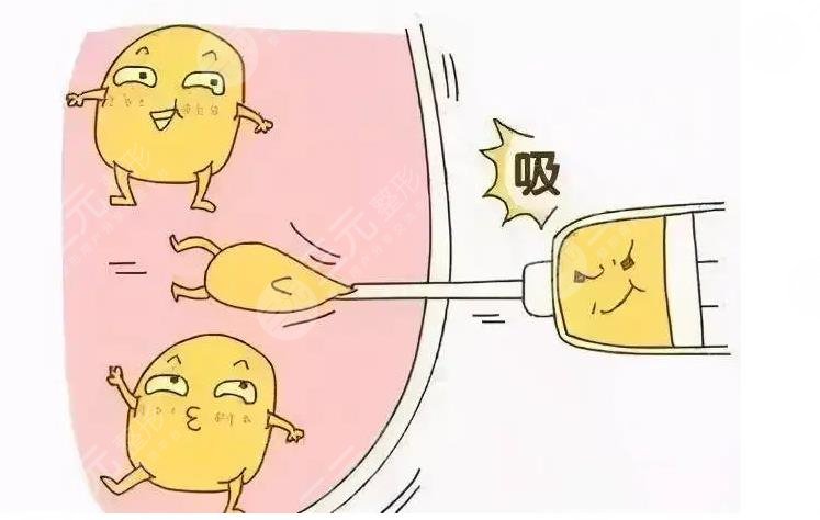 吸脂減肥會(huì)反彈嗎?