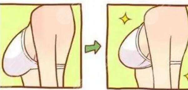 胸部整形手術(shù)改良乳房下垂