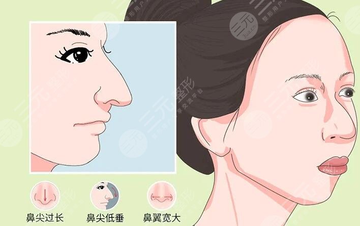 鷹鉤鼻整容整形手術(shù)多少錢2023同步更新！術(shù)前準(zhǔn)備及術(shù)后注意事項(xiàng)牢記于心！