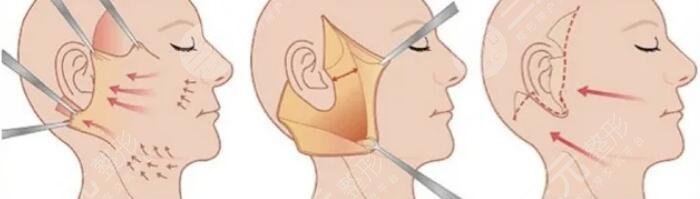 小切口拉皮除皺術需要注意什么呢?