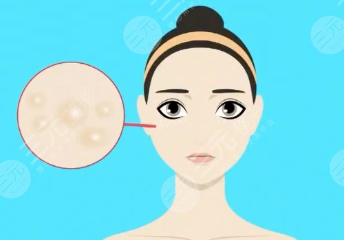 臉部長有脂肪粒是怎么回事？