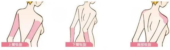 手臂吸脂的恢復(fù)期長嗎?