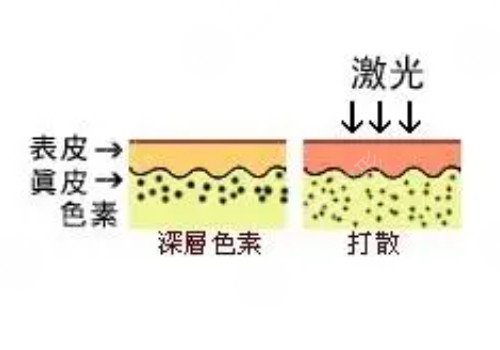 激光美容的利和弊有哪些？