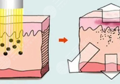 激光美容的利和弊有哪些？