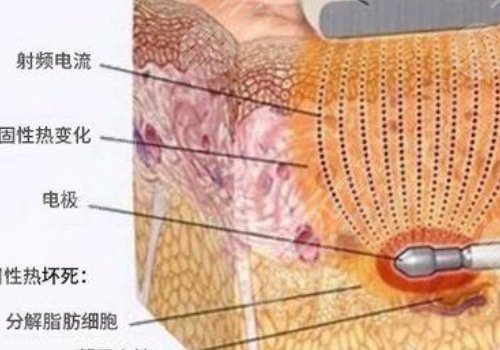 鐳射溶脂的危害有哪些？