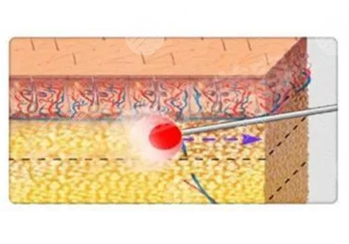 鐳射溶脂的危害有哪些？