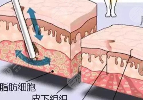 鐳射溶脂的危害有哪些？