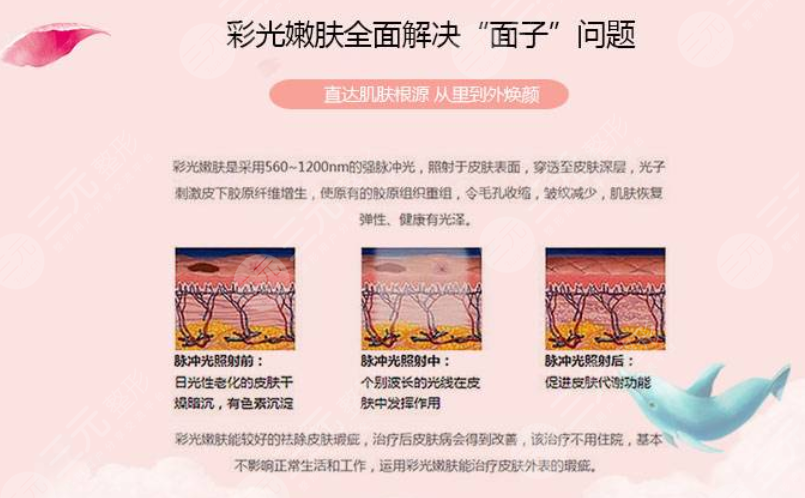 彩光嫩膚好嗎?要做?幾次?