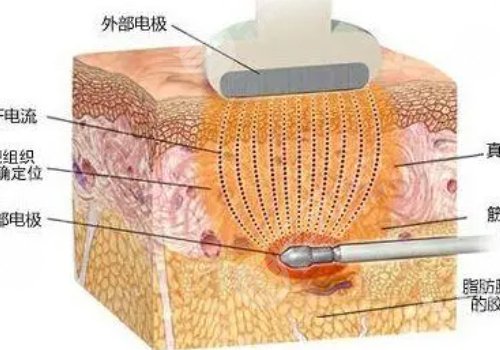 鐳射溶脂有效果嗎?