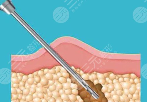 做了鐳射溶脂之后需要注意什么?