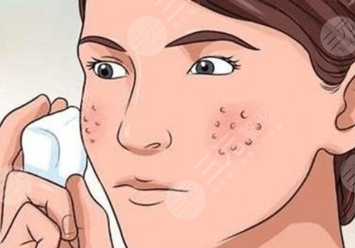 什么藥祛痘印痘坑效果好