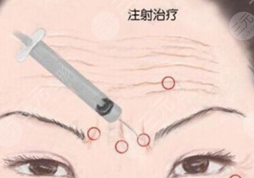 瑞蘭2號玻尿酸多少錢？