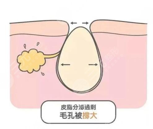男性毛孔粗大怎么辦?