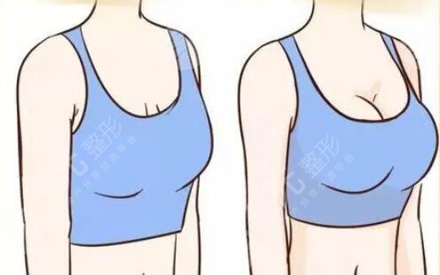 自體脂肪填充胸部