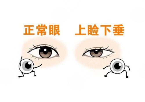 上瞼下垂矯正大概需要多少費用?