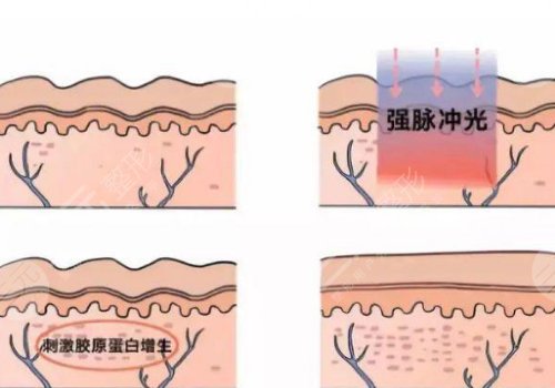 激光去疤痕需要幾次才能徹底消除？