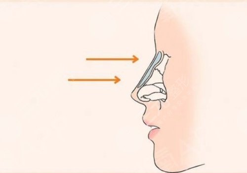 駝峰鼻矯正手術多少錢?