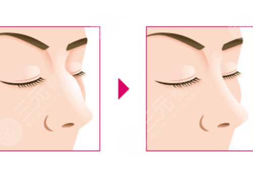 駝峰鼻矯正手術多少錢?