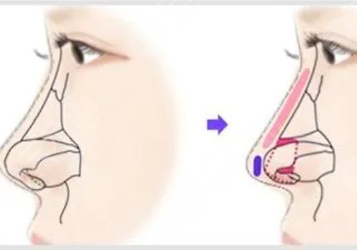 駝峰鼻矯正手術多少錢?
