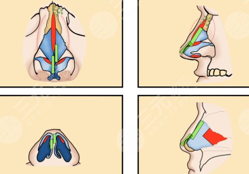 駝峰鼻矯正手術多少錢?